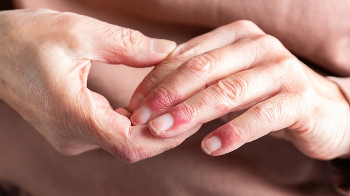 Hình Ảnh Viêm Da Cơ Địa Ở Người Lớn: Đánh Giá Trực Quan, Nguyên Nhân, Và Phương Pháp Điều Trị Hiệu Quả Cho Người Trưởng Thành
