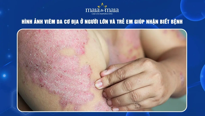 Hình Ảnh Viêm Da Cơ Địa Ở Người Lớn: Đánh Giá Trực Quan, Nguyên Nhân, Và Phương Pháp Điều Trị Hiệu Quả Cho Người Trưởng Thành