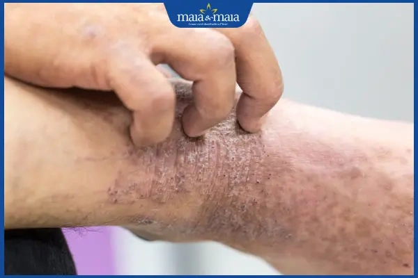 Hình Ảnh Viêm Da Cơ Địa Ở Người Lớn: Đánh Giá Trực Quan, Nguyên Nhân, Và Phương Pháp Điều Trị Hiệu Quả Cho Người Trưởng Thành