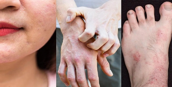 Hình Ảnh Viêm Da Cơ Địa Ở Người Lớn: Đánh Giá Trực Quan, Nguyên Nhân, Và Phương Pháp Điều Trị Hiệu Quả Cho Người Trưởng Thành