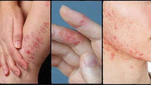 Hình Ảnh Viêm Da Cơ Địa Ở Người Lớn: Đánh Giá Trực Quan, Nguyên Nhân, Và Phương Pháp Điều Trị Hiệu Quả Cho Người Trưởng Thành