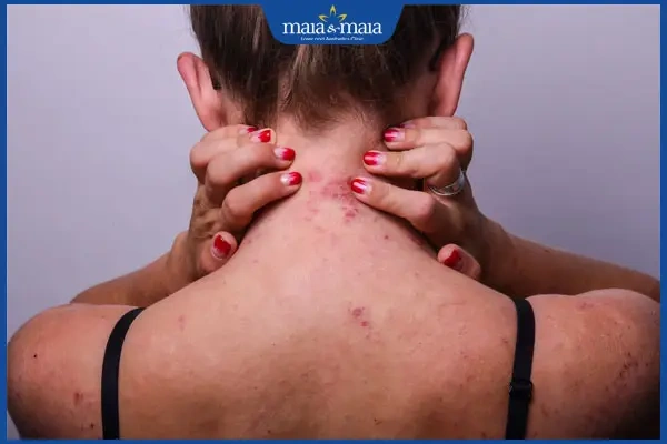 Hình Ảnh Viêm Da Cơ Địa Ở Người Lớn: Đánh Giá Trực Quan, Nguyên Nhân, Và Phương Pháp Điều Trị Hiệu Quả Cho Người Trưởng Thành