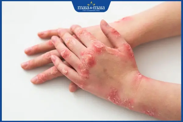 Hình Ảnh Viêm Da Cơ Địa Ở Người Lớn: Đánh Giá Trực Quan, Nguyên Nhân, Và Phương Pháp Điều Trị Hiệu Quả Cho Người Trưởng Thành