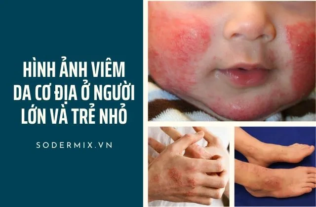 Hình Ảnh Viêm Da Cơ Địa Ở Người Lớn: Đánh Giá Trực Quan, Nguyên Nhân, Và Phương Pháp Điều Trị Hiệu Quả Cho Người Trưởng Thành