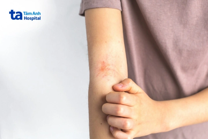 Hình Ảnh Viêm Da Cơ Địa Ở Người Lớn: Đánh Giá Trực Quan, Nguyên Nhân, Và Phương Pháp Điều Trị Hiệu Quả Cho Người Trưởng Thành