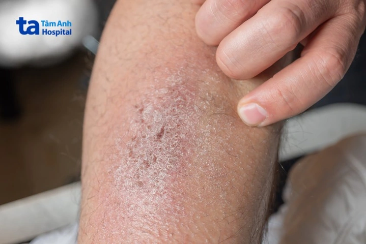 Hình Ảnh Viêm Da Cơ Địa Ở Người Lớn: Đánh Giá Trực Quan, Nguyên Nhân, Và Phương Pháp Điều Trị Hiệu Quả Cho Người Trưởng Thành