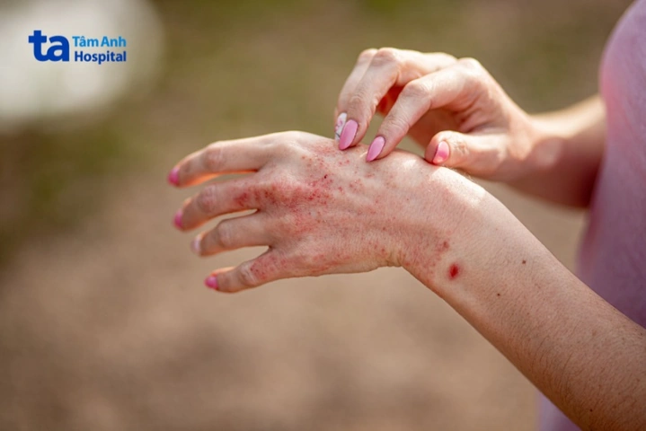 Hình Ảnh Viêm Da Cơ Địa Ở Người Lớn: Đánh Giá Trực Quan, Nguyên Nhân, Và Phương Pháp Điều Trị Hiệu Quả Cho Người Trưởng Thành