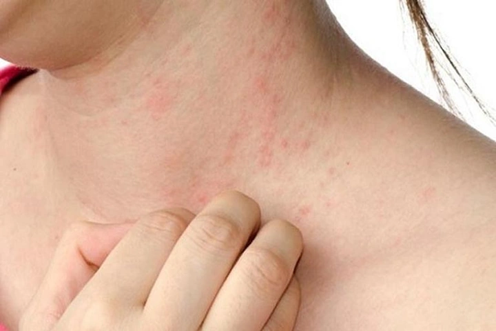 Hình Ảnh Viêm Da Cơ Địa Ở Người Lớn: Đánh Giá Trực Quan, Nguyên Nhân, Và Phương Pháp Điều Trị Hiệu Quả Cho Người Trưởng Thành