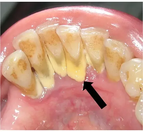Xem Hình Ảnh Vôi Răng Thực Tế Và Phân Biệt Các Cấp Độ Vôi Răng Ở Người Trưởng Thành