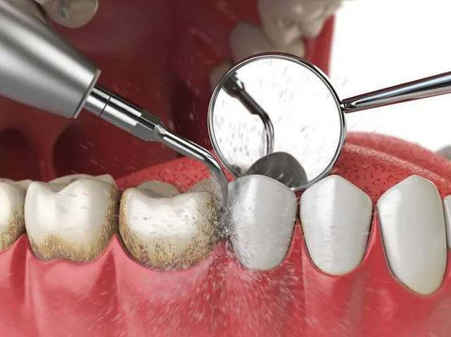 Xem Hình Ảnh Vôi Răng Thực Tế Và Phân Biệt Các Cấp Độ Vôi Răng Ở Người Trưởng Thành