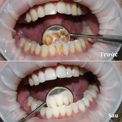 Xem Hình Ảnh Vôi Răng Thực Tế Và Phân Biệt Các Cấp Độ Vôi Răng Ở Người Trưởng Thành