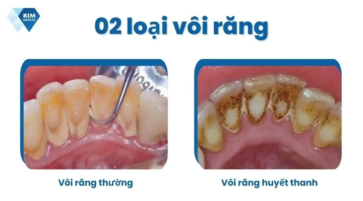 Xem Hình Ảnh Vôi Răng Thực Tế Và Phân Biệt Các Cấp Độ Vôi Răng Ở Người Trưởng Thành