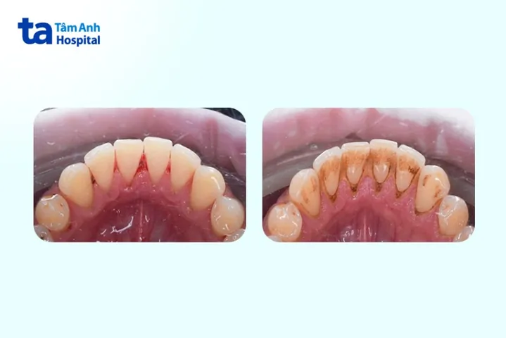 Xem Hình Ảnh Vôi Răng Thực Tế Và Phân Biệt Các Cấp Độ Vôi Răng Ở Người Trưởng Thành