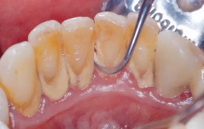 Xem Hình Ảnh Vôi Răng Thực Tế Và Phân Biệt Các Cấp Độ Vôi Răng Ở Người Trưởng Thành