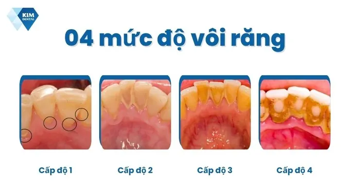 Xem Hình Ảnh Vôi Răng Thực Tế Và Phân Biệt Các Cấp Độ Vôi Răng Ở Người Trưởng Thành