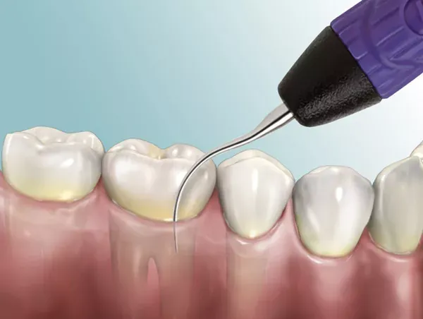 Xem Hình Ảnh Vôi Răng Thực Tế Và Phân Biệt Các Cấp Độ Vôi Răng Ở Người Trưởng Thành