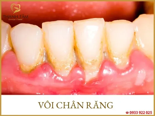Xem Hình Ảnh Vôi Răng Thực Tế Và Phân Biệt Các Cấp Độ Vôi Răng Ở Người Trưởng Thành