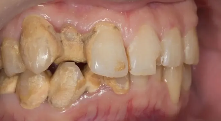 Xem Hình Ảnh Vôi Răng Thực Tế Và Phân Biệt Các Cấp Độ Vôi Răng Ở Người Trưởng Thành
