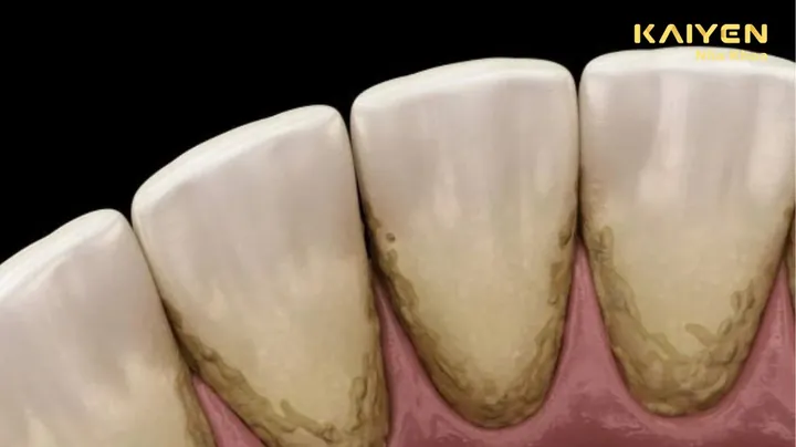Xem Hình Ảnh Vôi Răng Thực Tế Và Phân Biệt Các Cấp Độ Vôi Răng Ở Người Trưởng Thành