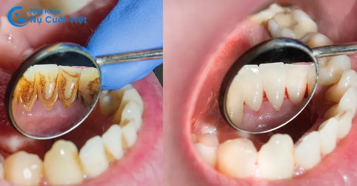 Xem Hình Ảnh Vôi Răng Thực Tế Và Phân Biệt Các Cấp Độ Vôi Răng Ở Người Trưởng Thành