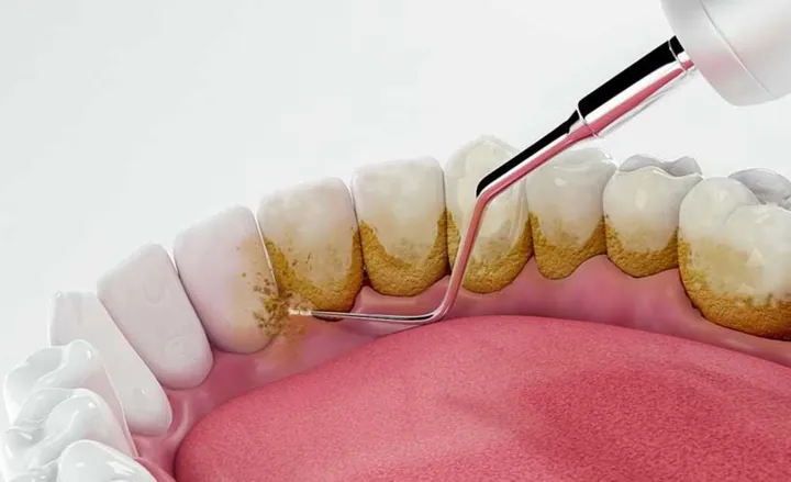 Xem Hình Ảnh Vôi Răng Thực Tế Và Phân Biệt Các Cấp Độ Vôi Răng Ở Người Trưởng Thành