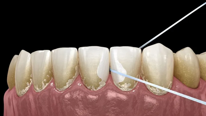 Xem Hình Ảnh Vôi Răng Thực Tế Và Phân Biệt Các Cấp Độ Vôi Răng Ở Người Trưởng Thành