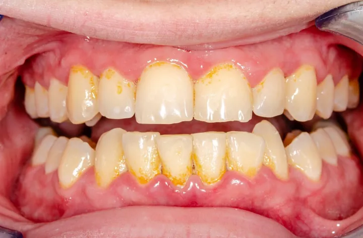 Xem Hình Ảnh Vôi Răng Thực Tế Và Phân Biệt Các Cấp Độ Vôi Răng Ở Người Trưởng Thành