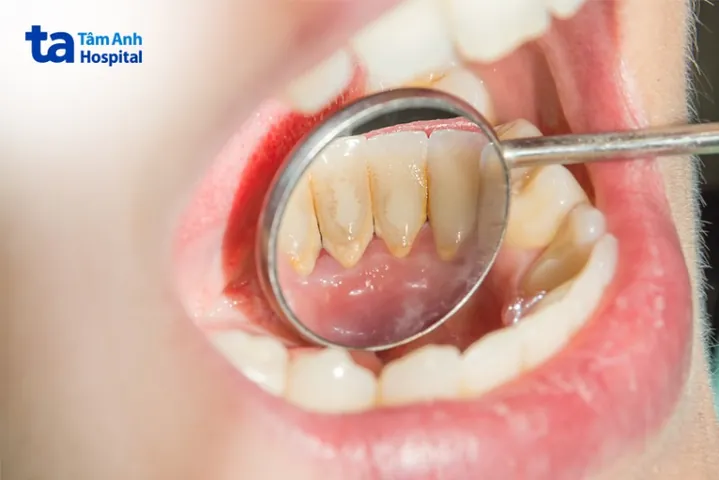 Xem Hình Ảnh Vôi Răng Thực Tế Và Phân Biệt Các Cấp Độ Vôi Răng Ở Người Trưởng Thành
