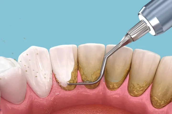 Xem Hình Ảnh Vôi Răng Thực Tế Và Phân Biệt Các Cấp Độ Vôi Răng Ở Người Trưởng Thành