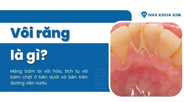 Xem Hình Ảnh Vôi Răng Thực Tế Và Phân Biệt Các Cấp Độ Vôi Răng Ở Người Trưởng Thành