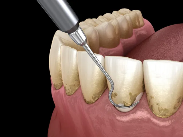 Xem Hình Ảnh Vôi Răng Thực Tế Và Phân Biệt Các Cấp Độ Vôi Răng Ở Người Trưởng Thành