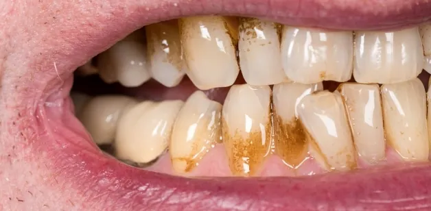 Xem Hình Ảnh Vôi Răng Thực Tế Và Phân Biệt Các Cấp Độ Vôi Răng Ở Người Trưởng Thành