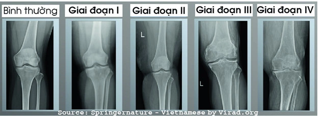 Hình Ảnh X‑quang Thoái Hóa Khớp Gối: Dấu Hiệu, Đánh Giá & Hướng Dẫn Chẩn Đoán Cho Bệnh Nhân Hình Ảnh X‑quang Thoái Hóa Khớp Gối: Dấu Hiệu, Đánh Giá & Hướng Dẫn Chẩn Đoán Cho Bệnh Nhân