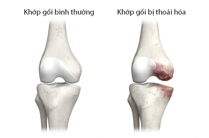 Hình Ảnh X‑quang Thoái Hóa Khớp Gối: Dấu Hiệu, Đánh Giá & Hướng Dẫn Chẩn Đoán Cho Bệnh Nhân Hình Ảnh X‑quang Thoái Hóa Khớp Gối: Dấu Hiệu, Đánh Giá & Hướng Dẫn Chẩn Đoán Cho Bệnh Nhân