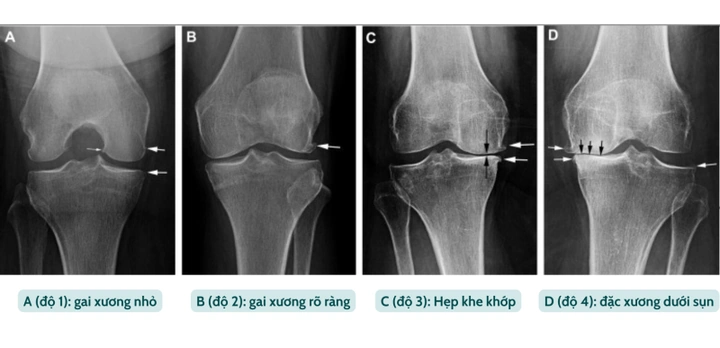 Hình Ảnh X‑quang Thoái Hóa Khớp Gối: Dấu Hiệu, Đánh Giá & Hướng Dẫn Chẩn Đoán Cho Bệnh Nhân Hình Ảnh X‑quang Thoái Hóa Khớp Gối: Dấu Hiệu, Đánh Giá & Hướng Dẫn Chẩn Đoán Cho Bệnh Nhân