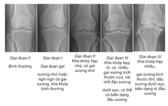 Hình Ảnh X‑quang Thoái Hóa Khớp Gối: Dấu Hiệu, Đánh Giá & Hướng Dẫn Chẩn Đoán Cho Bệnh Nhân Hình Ảnh X‑quang Thoái Hóa Khớp Gối: Dấu Hiệu, Đánh Giá & Hướng Dẫn Chẩn Đoán Cho Bệnh Nhân