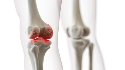 Hình Ảnh X‑quang Thoái Hóa Khớp Gối: Dấu Hiệu, Đánh Giá & Hướng Dẫn Chẩn Đoán Cho Bệnh Nhân Hình Ảnh X‑quang Thoái Hóa Khớp Gối: Dấu Hiệu, Đánh Giá & Hướng Dẫn Chẩn Đoán Cho Bệnh Nhân