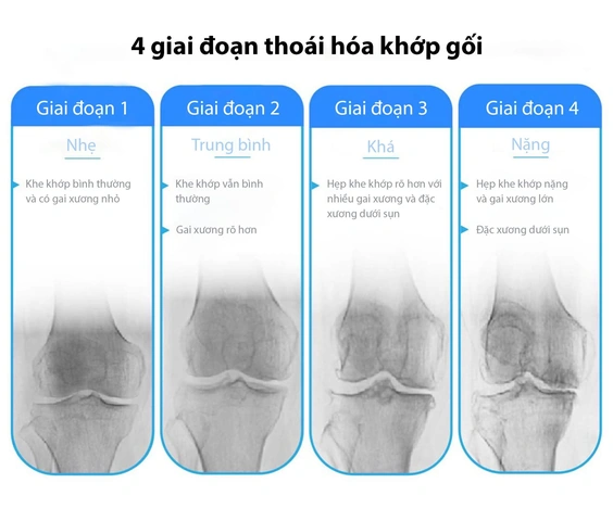 Hình Ảnh X‑quang Thoái Hóa Khớp Gối: Dấu Hiệu, Đánh Giá & Hướng Dẫn Chẩn Đoán Cho Bệnh Nhân Hình Ảnh X‑quang Thoái Hóa Khớp Gối: Dấu Hiệu, Đánh Giá & Hướng Dẫn Chẩn Đoán Cho Bệnh Nhân