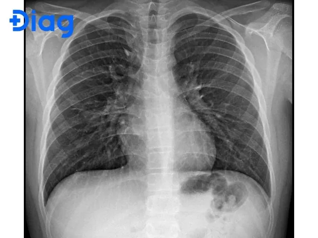 Nhận Diện Hình Ảnh Xquang Phổi Bình Thường Và Bất Thường Cho Người Đọc Phổ Thông Nhận Diện Hình Ảnh Xquang Phổi Bình Thường Và Bất Thường Cho Người Đọc Phổ Thông