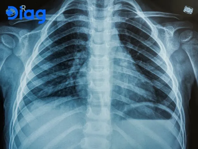 Nhận Diện Hình Ảnh Xquang Phổi Bình Thường Và Bất Thường Cho Người Đọc Phổ Thông Nhận Diện Hình Ảnh Xquang Phổi Bình Thường Và Bất Thường Cho Người Đọc Phổ Thông