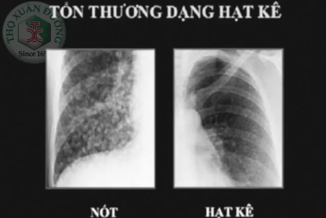 Nhận Diện Hình Ảnh Xquang Phổi Bình Thường Và Bất Thường Cho Người Đọc Phổ Thông Nhận Diện Hình Ảnh Xquang Phổi Bình Thường Và Bất Thường Cho Người Đọc Phổ Thông