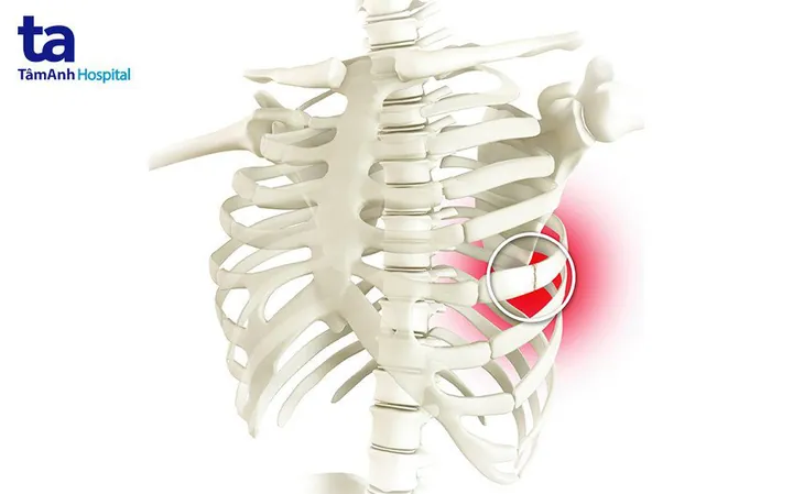 Xem Hình Ảnh Xương Sườn Người: Cấu Tạo Lồng Ngực Và Các Loại Xương Sườn Thật Giả Xem Hình Ảnh Xương Sườn Người: Cấu Tạo Lồng Ngực Và Các Loại Xương Sườn Thật Giả
