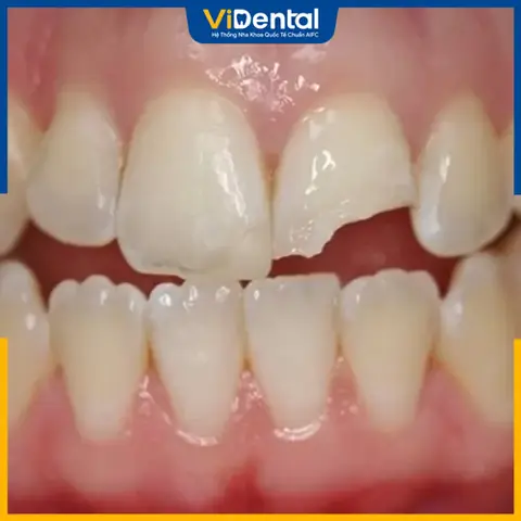 Giải Mã Giấc Mơ Gãy Răng Cửa: Điềm Báo, Ý Nghĩa Theo Trạng Thái Và Con Số May Mắn Giải Mã Giấc Mơ Gãy Răng Cửa: Điềm Báo, Ý Nghĩa Theo Trạng Thái Và Con Số May Mắn