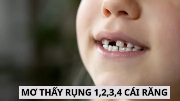 Giải Mã Giấc Mơ Rụng 1 Cái Răng: Điềm Báo Tốt Hay Xấu Và Ý Nghĩa Tâm Lý
