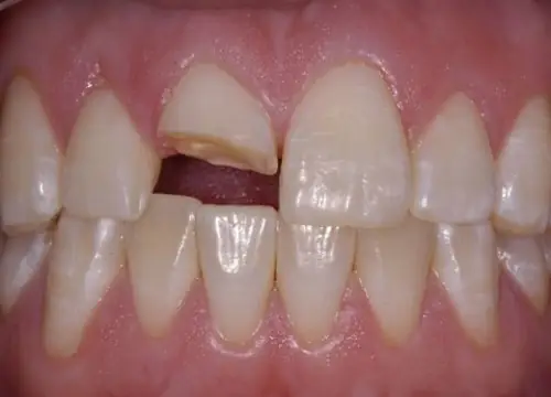 Giải Mã Giấc Mơ Gãy Răng Cửa Hàm Trên: Điềm Báo Và Ý Nghĩa Chi Tiết Giải Mã Giấc Mơ Gãy Răng Cửa Hàm Trên: Điềm Báo Và Ý Nghĩa Chi Tiết