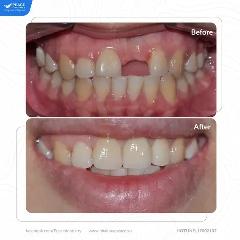 Giải Mã Giấc Mơ Gãy Răng Cửa Hàm Trên: Điềm Báo Và Ý Nghĩa Chi Tiết Giải Mã Giấc Mơ Gãy Răng Cửa Hàm Trên: Điềm Báo Và Ý Nghĩa Chi Tiết