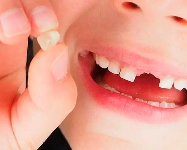 Giải Mã Giấc Mơ Gãy Răng Cửa Hàm Trên: Điềm Báo Và Ý Nghĩa Chi Tiết Giải Mã Giấc Mơ Gãy Răng Cửa Hàm Trên: Điềm Báo Và Ý Nghĩa Chi Tiết