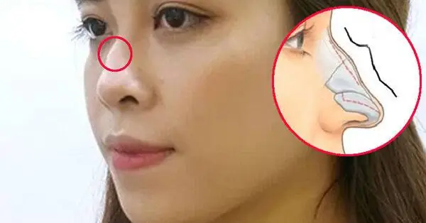 Ý Nghĩa Tướng Mũi Gồ Theo Nhân Tướng Học: Ảnh Hưởng Vận Số & Cách Khắc Phục Hiệu Quả Ý Nghĩa Tướng Mũi Gồ Theo Nhân Tướng Học: Ảnh Hưởng Vận Số & Cách Khắc Phục Hiệu Quả