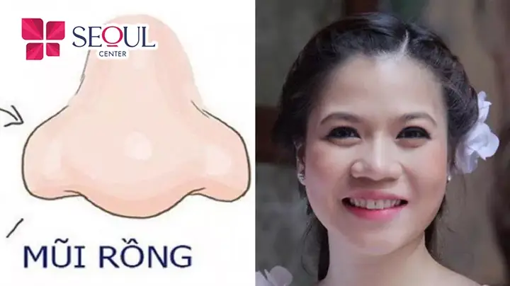 Giải Mã Tướng Mũi Rồng (long Tý): Đặc Điểm Nhận Diện, Ý Nghĩa Vận Mệnh Nam/nữ & Xu Hướng Thẩm Mỹ Giải Mã Tướng Mũi Rồng (long Tý): Đặc Điểm Nhận Diện, Ý Nghĩa Vận Mệnh Nam/nữ & Xu Hướng Thẩm Mỹ