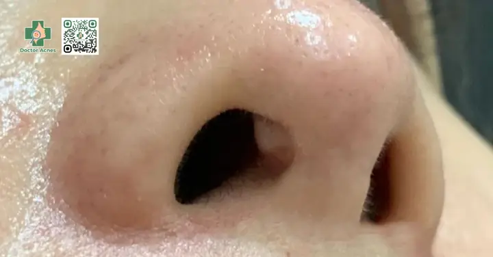 Giải Mã Mụn Mọc Ở Mũi Báo Hiệu Gì Về Sức Khỏe Theo Từng Vị Trí Giải Mã Mụn Mọc Ở Mũi Báo Hiệu Gì Về Sức Khỏe Theo Từng Vị Trí